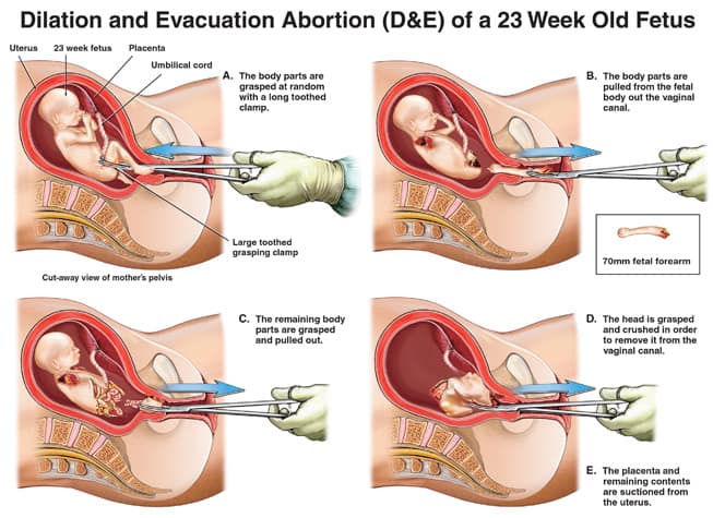 an abortion doctor describes a de 02