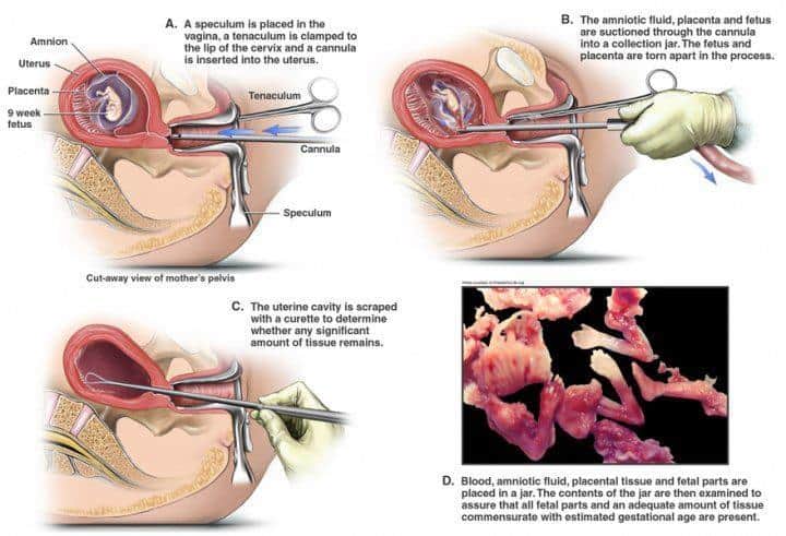 an abortion doctor describes a de 02